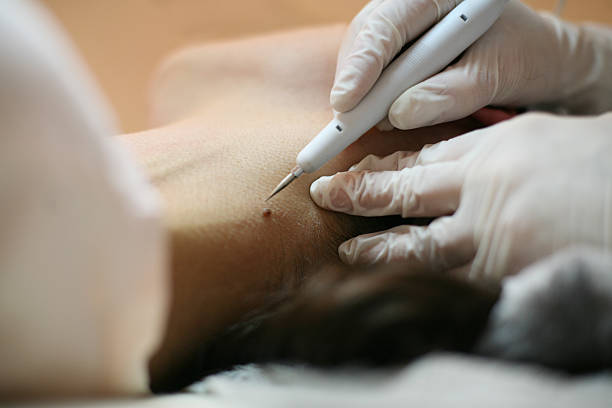 Skin Tags, Moles, Milia Removal